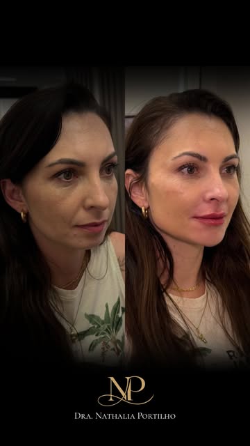Comparação de antes e depois de um caso publicado pela Nathália, com as imagens lado a lado na composição original.