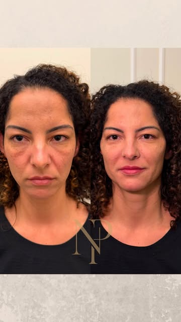 Comparação frontal de antes e depois de um planejamento facial publicado pela Nathália, preservada na composição original.